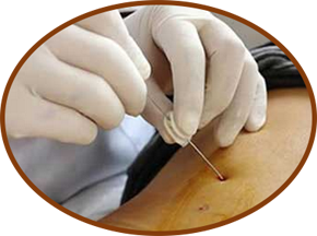 小圆针 针疗法图片